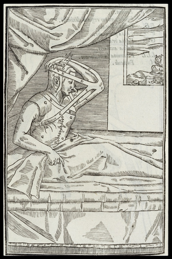 Illustration from Gaspare Tagliacozzi's treatise De curtorum chirurgia per insitionem (1597): a patient with his arm strapped against his face for the nose graft